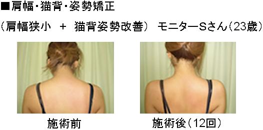 ◎ｳｪﾙﾈｽ整体院<br />
<br />
肩幅矯正･肩幅狭小矯正･姿勢矯正の専門整体院｡<br />
開院18年の実績｡(2001年開院)<br />
肩幅は､ﾌﾟﾛﾎﾟｰｼｮﾝの大切な要素の1つです｡<br />
肩幅が広い､巻き肩､いかり肩､猫背､等が気になる方は､当院独自の矯正法で､<br />
肩幅を少し狭くし､ﾅﾁｭﾗﾙな女性らしいｼｮﾙﾀﾞｰﾗｲﾝと､きれいな背姿を実現します｡