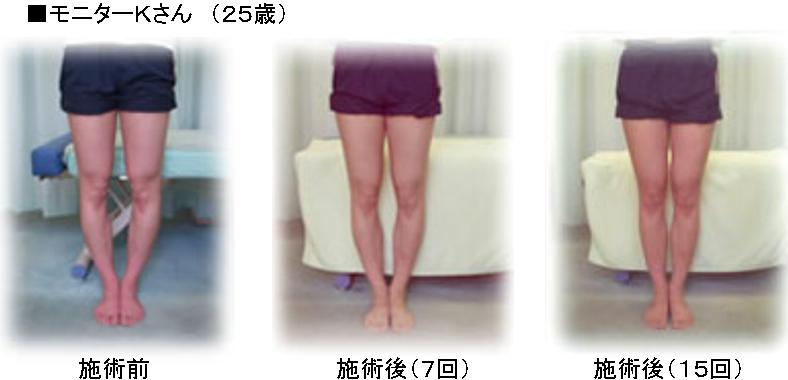 ◎ｳｪﾙﾈｽ整体院<br />
<br />
肩幅矯正･肩幅狭小矯正･姿勢矯正の専門整体院｡<br />
開院18年の実績｡(2001年開院)<br />
肩幅は､ﾌﾟﾛﾎﾟｰｼｮﾝの大切な要素の1つです｡<br />
肩幅が広い､巻き肩､いかり肩､猫背､等が気になる方は､当院独自の矯正法で､<br />
肩幅を少し狭くし､ﾅﾁｭﾗﾙな女性らしいｼｮﾙﾀﾞｰﾗｲﾝと､きれいな背姿を実現します｡